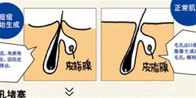 編制痘痘對抗完全手冊 讓你重現柔嫩美肌