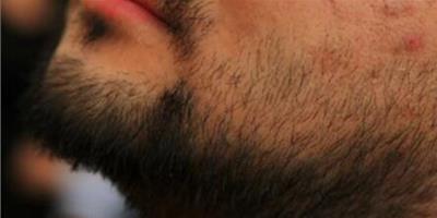 鬍子長得快怎麼辦？ 4個妙招減緩鬍子生長速度