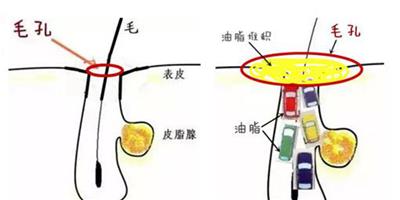 還在為毛孔粗大煩惱？完美蛋白肌只要五步就足夠