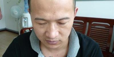 如何擺脫遺傳性脫髮困擾 下面教你如何防治脫髮