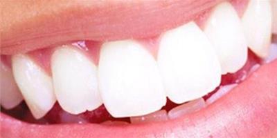 牙齒白斑洗牙可以去除嗎 8大方法讓你的牙齒潔白如雪