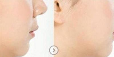 吸脂去除雙下巴過程分享 介紹該手術的優點及方法