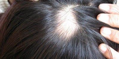 頭髮油膩脫髮的原因是什麼 如何預防和治療