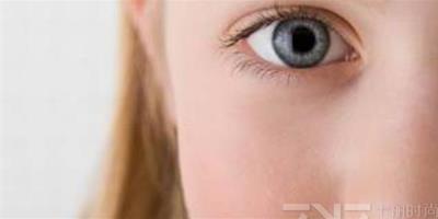 美瞳線紋後眼睛腫 教你正確術後消腫方法