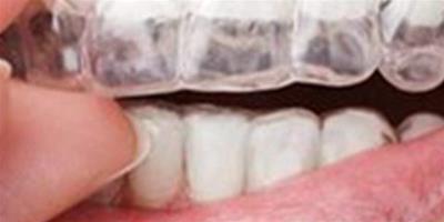 介紹十八歲還能矯正牙齒嗎 快速瞭解牙齒矯正的黃金時期