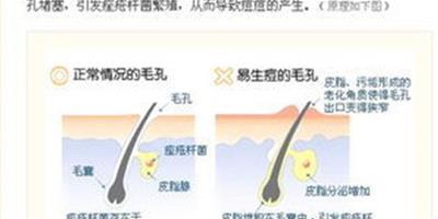 臉上突然長了很多痘痘是什麼原因 找出6大原因