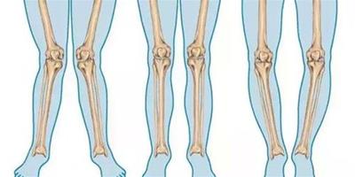 怎樣糾正x型腿 教你三個動作糾正X型腿