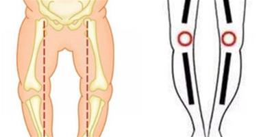 羅圈腿能矯正嗎 這些方法能擁有一雙美腿