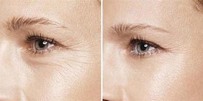 六個小妙方怎麼去眼角皺紋 讓你重拾光滑的眼周肌膚