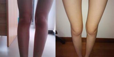o型腿可以治療嗎 堅持做矯正操助你改善腿型
