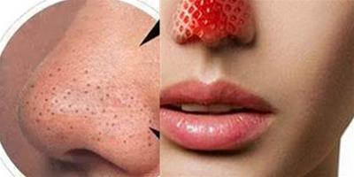 詳解造成草莓鼻凸起的原因 教你輕鬆應對皮膚問題