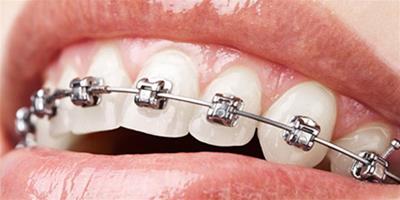 牙齒矯正過程圖 牙齒矯正過程詳解