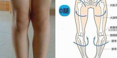o型腿是否遺傳 教你如何擁有一雙美腿