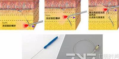光纖溶脂多久消腫 這樣護理能加快光纖溶脂消腫