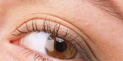 壓線雙眼皮恢復過程展示 術後注意事項須謹記