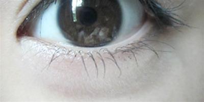 埋線割雙眼皮能維持多久 2個因素影響雙眼皮手術效果