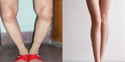 o型腿可以治療嗎 美麗大長腿原來是這麼簡單