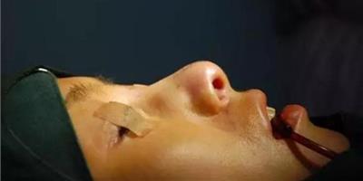 鼻綜合手術是怎麼做的 鼻綜合手術過程圖解析
