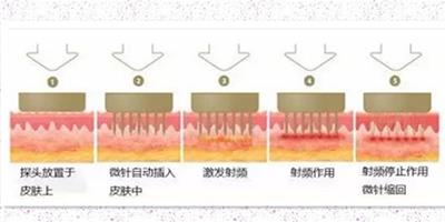 微針去痘坑效果好不好 嚴重痘坑不建議做微針治療