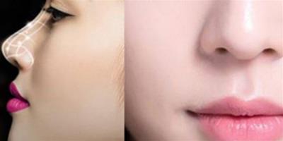 鼻子整形一個月能消腫嗎 幾個妙招幫你打造完美鼻型