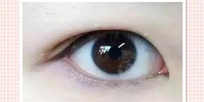 腫眼泡可以做埋線雙眼皮嗎 腫眼泡做重瞼先吸脂後全切