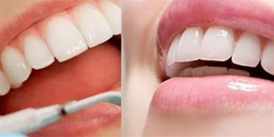 牙釉質發育不全是怎麼回事 幾個分析教你如何避免