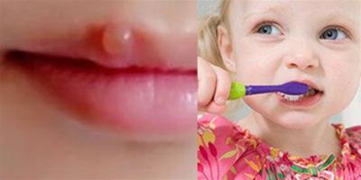 嘴唇長泡抹牙膏可降火 效果微弱醫生建議服用專用藥
