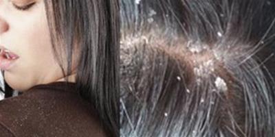 解答頭皮乾燥頭屑多怎麼辦 這樣做讓你的秀髮更清爽