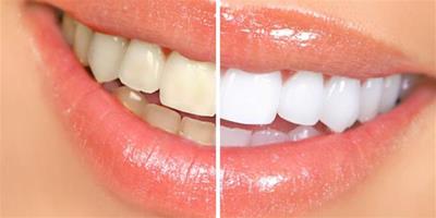 如何潔白牙齒 讓你的笑容更加迷人