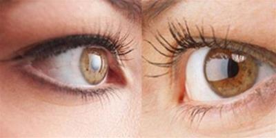 眼瞼發炎怎麼辦才好 眼部問題的產生原因