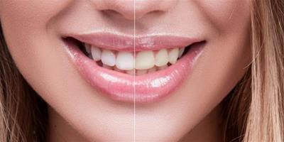 美白牙貼對牙齒有傷害嗎 這些小內容你是否牢記了
