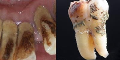 應該如何快速清除牙石 讓你的口腔保持健康要做到這些