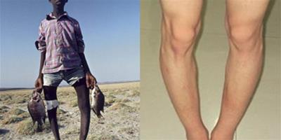 父母是羅圈腿遺傳嗎 造成膝內翻不僅是先天性原因