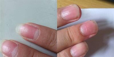 手指甲凹凸不平是什麼原因 身體在警示你