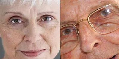老年斑的形成原因有兩個 主要還是肌膚活性降低所導致