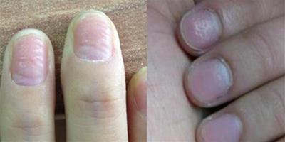 指甲上凹凸不平 可能會引起某些疾病的發生