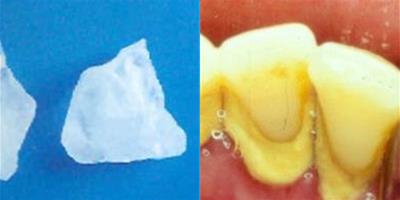 如何清除牙石 這些方法可以幫助你