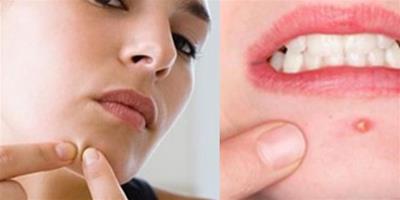 嘴角長痘痘是什麼原因 正確護理方式你學會了嗎