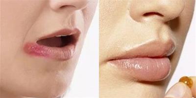 嘴唇上長泡是怎麼回事 因為你的身體少了它