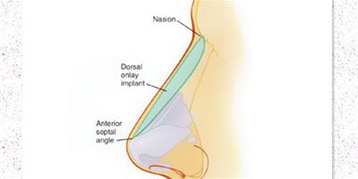 膨體隆鼻鼻頭多久恢復 1個月消腫3-6個月軟化至正常