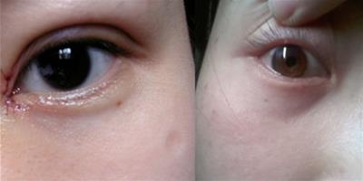開眼角後疤痕增生怎麼辦 教你如何護理肌膚