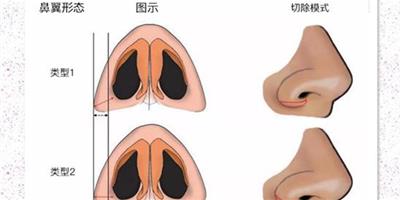 鼻翼縮小安全嗎 縮鼻翼術前術後保證這4點更安全