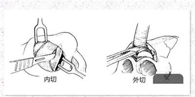 鼻翼內切是切鼻基底嗎 內切鼻翼切口在鼻子裡面