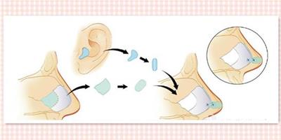 鼻小柱延長用什麼材料 可優先選擇鼻中隔軟骨