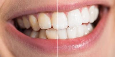 牙根尖周炎是怎麼形成的 與細菌感染息息相關