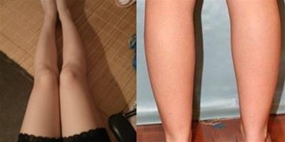 水腫腿脂肪腿怎麼區分 不同類型需要特定鍛煉方法