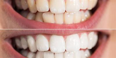 洗牙後吃東西注意事項有哪些 保護牙齒的妙招知多少