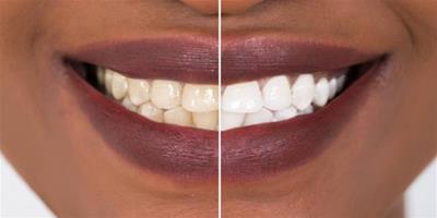 牙齒黑斑怎麼去除 幾個建議幫你打造亮白笑容