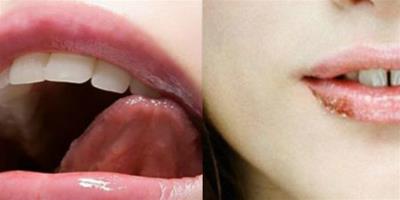 嘴角起泡是什麼原因 教你幾招迅速恢復健康