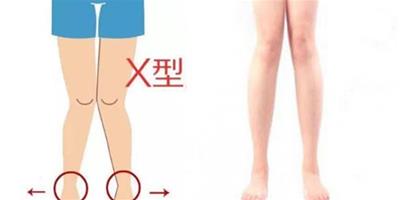 人的腿型分類圖示 看看自己屬於哪一種